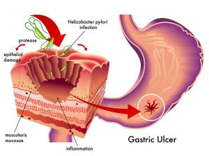 Illustration for article titled Obat Maag Kronis Resep Dokter